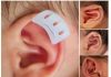 Complete Guide to Non-Surgical Newborn Ear Correction – Clinical Practice & Home Use of babyearfix Baby Ear Corrector babyearfix