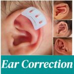 Complete Guide to Non-Surgical Newborn Ear Correction – Clinical Practice & Home Use of babyearfix Baby Ear Corrector babyearfix