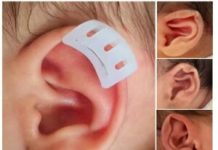 Complete Guide to Non-Surgical Newborn Ear Correction – Clinical Practice & Home Use of babyearfix Baby Ear Corrector babyearfix